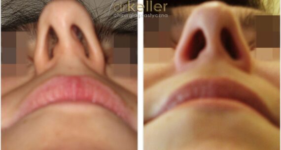po lewej zdjęcie od dołu nosa z krzywą przegrodą, po prawej po korekcji przegrody nosa
