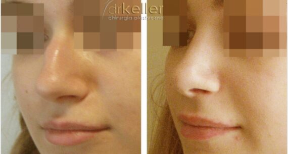 po lewej portret kobiety z garbatym nosem, po prawej po plastyce nosa