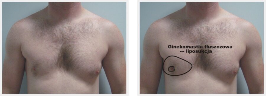 po lewej klatka piersiowa męska, po prawej z napisem ginekomastia tłuszczowa