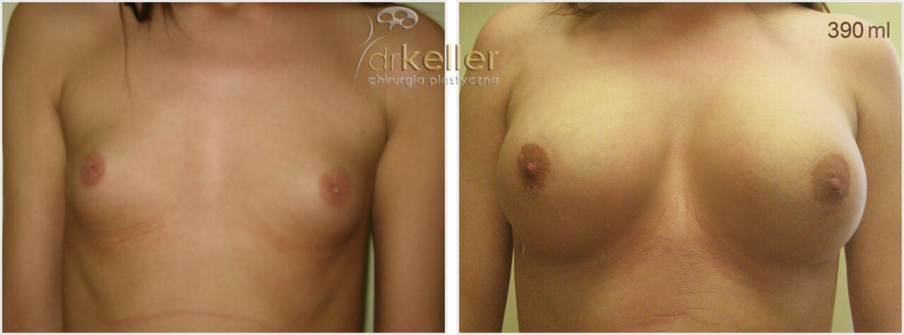 Po praawej klatka piersiowa pacjentki transseksualnej z małymi piersiami, po lewej po wszczepieniu implantów piersiowych