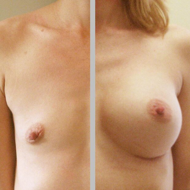 Jedna pierś przed zabiegiem i druga pierś po zabiegu wszczepienia implantu piersi.